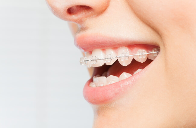 woman wearing clear braces at Allen and Allen Orthodontics